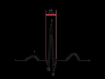 800px-ECG-PQRSkomplexT.svg.gif