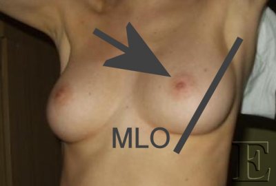 mammo_MLO