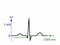 800px-ECG-krivkameritka.gif